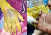 गाजियाबाद में डॉक्टर की लापरवाही से महिला की काटनी पड़ी चार उंगलियां